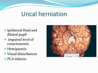 Uncal herniation
 ipsilateral fixed and
dilated pupil
 impaired level of
consciousness
 Hemiparesis
 Visual disturbances
 PCA infarcts
 