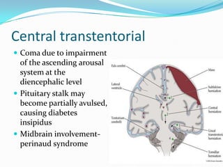 Central transtentorial
 Coma due to impairment
of the ascending arousal
system at the
diencephalic level
 Pituitary stalk may
become partially avulsed,
causing diabetes
insipidus
 Midbrain involvement-
perinaud syndrome
 