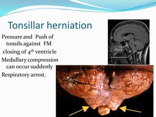 Tonsillar herniation
Pressure and Push of
tonsils against FM
closing of 4th ventricle
Medullary compression
can occur suddenly
Respiratory arrest.
 