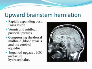 Upward brainstem herniation
 Rapidly expanding post.
Fossa lesion
 Vermis and midbrain
pushed upwards
 Compressing the dorsal
midbrain ,blood vessels
and the cerebral
aqueduct.
 Impaired upgaze , LOC
and acute
hydrocephalus.
 