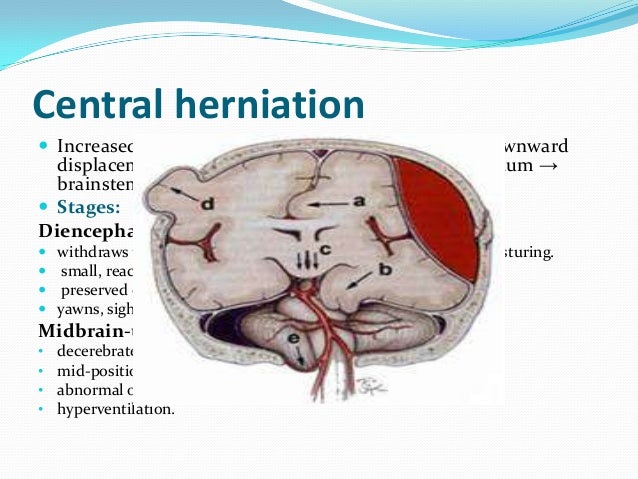 Raised Intracranial Pressure