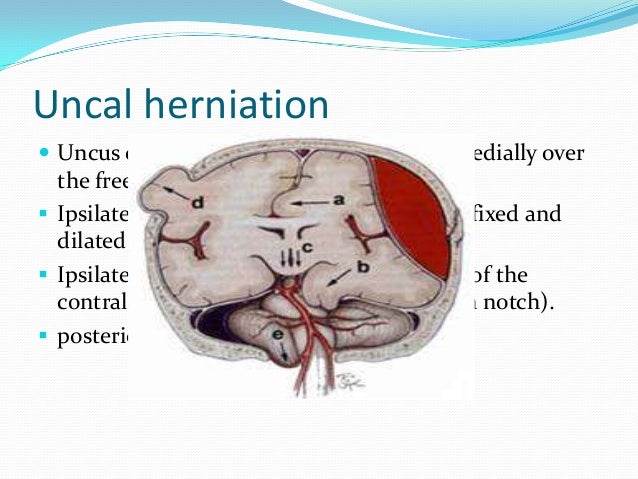 Raised Intracranial Pressure Raised Intracranial Pressure