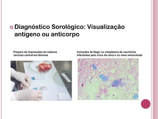  Diagnóstico Sorológico: Visualização
antígeno ou anticorpo
Preparo de impressões do sistema
nervoso central em lâminas
Inclusões de Negri no citoplasma de neurônios
infectados pelo vírus da raiva e no meio extracelular
 