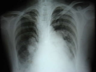 X-Ray - ASD | PPTX