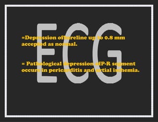 =Depression ofbareline up to 0.8 mm
accepted as normal.
= Pathological depression ofP-R segment
occurs in pericarditis and artial ischemia.
 