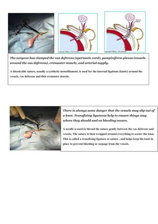 The surgeon has clamped the vas deferens (spermatic cord), pampiniform plexus (vessels 
around the vas deferens), cremaster muscle, and arterial supply. 
A dissolvable suture, usually a synthetic monofilament, is used for the internal ligations (knots) around the 
vessels, vas deferens and thin cremaster muscle. 
There is always some danger that the vessels may slip out of 
a knot. Transfixing ligatures help to ensure things stay 
where they should and no bleeding occurs. 
A needle is used to thread the suture gently between the vas deferens and 
vessels. The suture is then wrapped around everything to secure the knot. 
This is called a transfixing ligature or suture , and helps keep the knot in 
place to prevent bleeding or seepage from the vessels. 
 