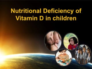 Nutritional Deficiency of
 Vitamin D in children
 