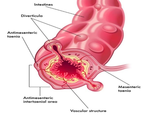 complicated diverticular disease