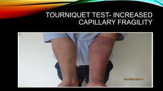 Approach to febrile illness and common tropical fever.pptx