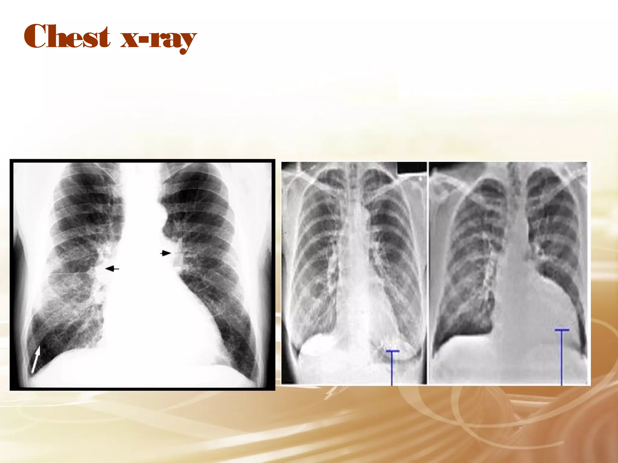 Chest x-ray

 