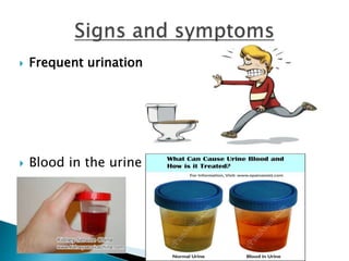  Frequent urination
 Blood in the urine
 