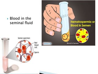  Blood in the
seminal fluid
 