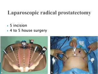  5 incision
 4 to 5 house surgery
 