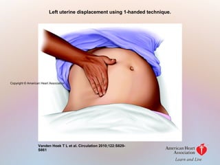 Left uterine displacement using 1-handed technique.
Vanden Hoek T L et al. Circulation 2010;122:S829-
S861
Copyright © American Heart Association
 