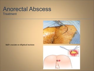 Anorectal Abscess
Treatment
I&D- cruciate or elliptical incision
 
