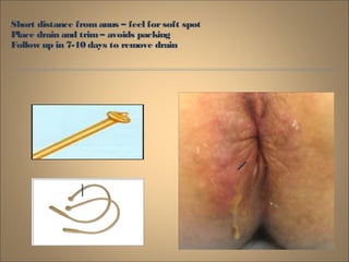 Short distance fromanus – feel forsoft spot
Place drain and trim– avoids packing
Follow up in 7-10 days to remove drain
 