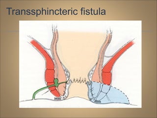 Transsphincteric fistula
 