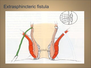 Extrasphincteric fistula
 
