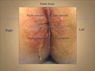 Tailbone
Right anterior
Right posterior
Left anterior
Left posterior
Right Left
Pubic bone
 
