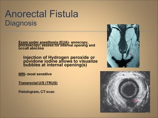 Anorectal Fistula
Diagnosis
 