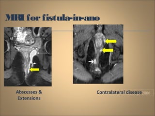 MRI forfistula-in-ano
HALLIGAN Radiology 2006Abscesses &
Extensions
Contralateral disease
 