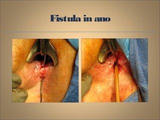 Fistula in ano
 