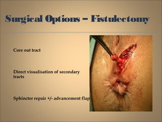 Surgical Options – Fistulectomy
• Core out tract
• Direct visualisation of secondary
tracts
• Sphincter repair +/- advancement flap
 