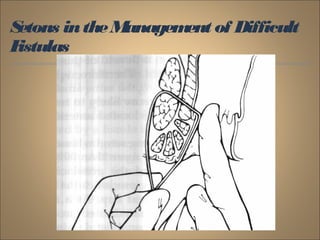 Setons intheManagement of Difficult
Fistulas
 