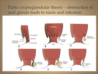 Parks cryptoglandular theory - obstruction of
anal glands leads to stasis and infection
 