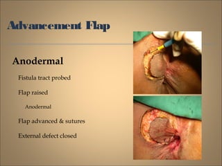 Advancement Flap
Anodermal
Fistula tract probed
Flap raised
Anodermal
Flap advanced & sutures
External defect closed
 