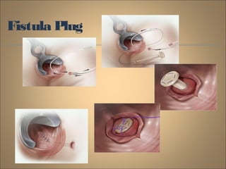 Fistula Plug
 