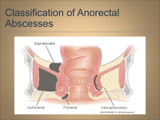 Classification of Anorectal
Abscesses
 