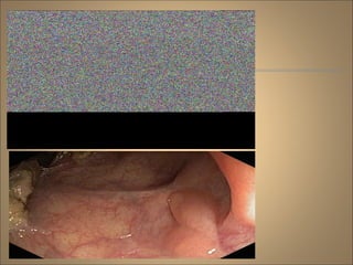 Rakesh  benign-anorectal-