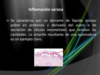 Inflamación serosa


Se caracteriza por un derrame de líquido acuoso
pobre en proteínas y derivado del suero o de
secreción de células mesoteliales que revisten las
cavidades. La ampolla resultante de una quemadura
es un ejemplo claro.

 