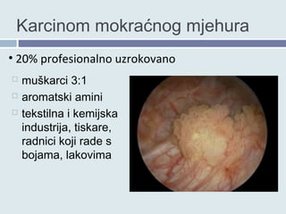 Sid Rakovina Muskat Rak kao profesionalna bolest | PPT