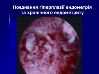 Поєднання гіперплазії ендометрія та хронічного ендометриту 