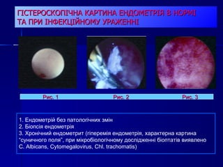 ГІСТЕРОСКОПІЧНА КАРТИНА ЕНДОМЕТРІЯ В НОРМІ  ТА ПРИ ІНФЕКЦІЙНОМУ УРАЖЕННІ Рис. 1  Рис. 2  Рис. 3 1. Ендометрій без патологічних змін 2. Біопсія ендометрія 3. Хронічний ендометрит (гіперемія ендометрія, характерна картина “суничного поля”, при мікробіологічному дослідженні біоптатів виявлено  C .  Albicans ,  Cytomegalovirus ,  Chl .  trachomatis ) 