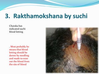 3. Rakthamokshana by suchi
Charaka has
indicated suchi
blood letting
. Most probably he
means that blood
letting should be
donne by needling
and made to ooze
out the blood from
the site of blood
 