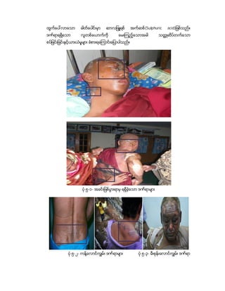ထļĶ္ıĕၚလĬıĞĬ         ဓါတ္ေပါင္းမွာ   ဆာလျဖဴရစ္          အက္ဆစ္(Sulphuric       acid)ျဖစ္သည္။
ဒဏ္ရာရရွိေသာ         လူတစ္ေယာက္ကို           ေမးၾကည့္ေသာအခါ              သတၳဳဆိပ္တက္ေသာ
စပ္ျဖင္းျဖင္းႏွင့္ယားယံမႈမ်ား ခံစားရေၾကာင္းေျပာပါသည္။




                      ပံု ၅-၁- အခင္းျဖစ္ပြားရာမွ ရရွိခဲ့ေသာ ဒဏ္ရာမ်ား




             ပံု ၅-၂- ကန္႔ေလာင္ကြ်မ္း ဒဏ္ရာမ်ား             ပံု ၅-၃- မီးစုန္း ေလာင္ကြ်မ္း ဒဏ္ရာ
 