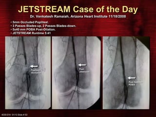 Jet Stream Pathway Device in Peripheral Arterial Disease. | PDF