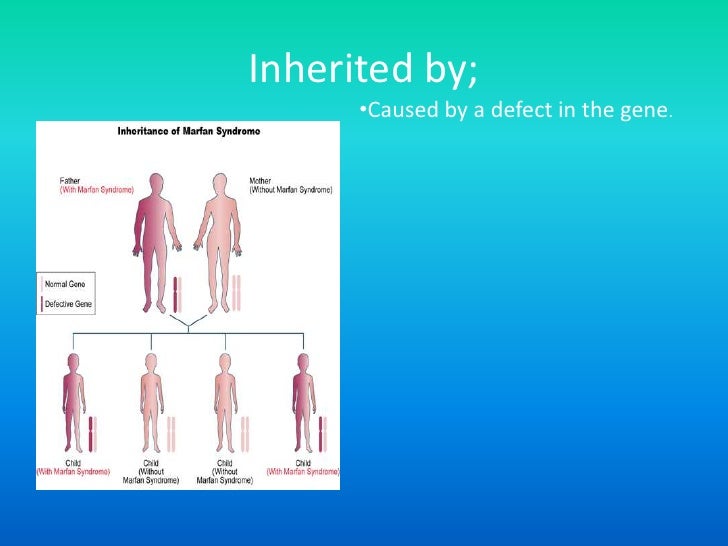 Marfan Syndrome