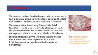 Ram Optometry Retinal Artery Macroaneurysm | PPTX