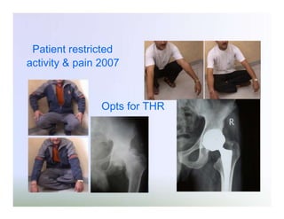 Patient restricted
activity & pain 2007

Opts for THR

 