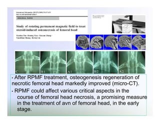 After RPMF treatment, osteogenesis regeneration of
necrotic femoral head markedly improved (micro-CT).
• RPMF could affect various critical aspects in the
course of femoral head necrosis, a promising measure
in the treatment of avn of femoral head, in the early
stage.
•

 