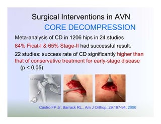 Surgical Interventions in AVN
CORE DECOMPRESSION
Meta-analysis of CD in 1206 hips in 24 studies
84% Ficat-I & 65% Stage-II had successful result.

22 studies: success rate of CD significantly higher than
that of conservative treatment for early-stage disease
(p < 0.05)

Castro FP Jr, Barrack RL.. Am J Orthop.;29:187-94. 2000

 