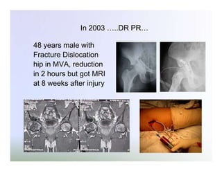 In 2003 …..DR PR…
48 years male with
Fracture Dislocation
hip in MVA, reduction
in 2 hours but got MRI
at 8 weeks after injury

 
