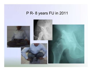 P R- 8 years FU in 2011

 