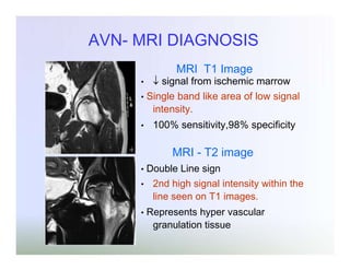 AVN- MRI DIAGNOSIS
MRI T1 Image

signal from ischemic marrow
• Single band like area of low signal
intensity.
•

•

100% sensitivity,98% specificity

MRI - T2 image
•
•

•

Double Line sign
2nd high signal intensity within the
line seen on T1 images.

Represents hyper vascular
granulation tissue

 