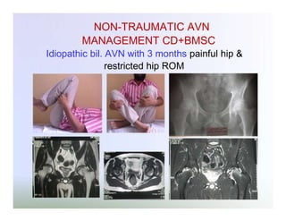 NON-TRAUMATIC AVN
MANAGEMENT CD+BMSC
Idiopathic bil. AVN with 3 months painful hip &
restricted hip ROM

 