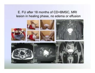 E. FU after 18 months of CD+BMSC, MRI
lesion in healing phase, no edema or effusion

 